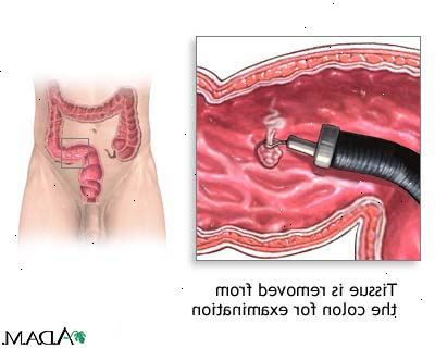 Colon polyyppi poisto. jälkeen andndash; sairaalassa. Colon polyyppi poisto. jälkeen andndash; sairaalassa.