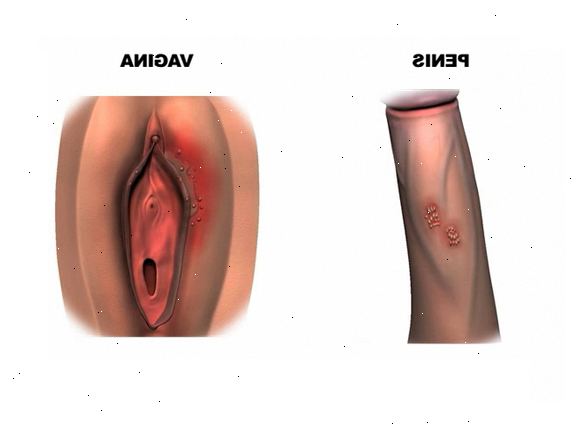 Sukupuolielinten herpes. Mikä on sukupuolielinten herpes? Sukupuolielinten herpes. Mikä on sukupuolielinten herpes?