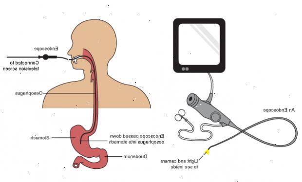 Gastroskopia. jälkeen andndash; sairaalassa. Gastroskopia. jälkeen andndash; sairaalassa.