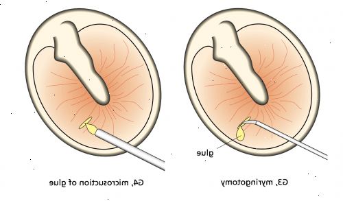 Läpivienti paikoilleen. jälkeen andndash; sairaalassa. Läpivienti paikoilleen. jälkeen andndash; sairaalassa.