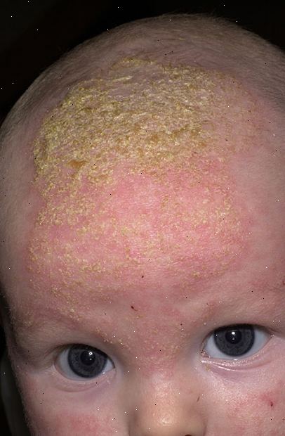 Cradle korkki (lapsuuden seborrhoeic ihottumaa). mitkä ovat oireet? Cradle korkki (lapsuuden seborrhoeic ihottumaa). mitkä ovat oireet?