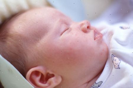 Infantiili ekseema. mikä on infantiili ekseema? Infantiili ekseema. mikä on infantiili ekseema?