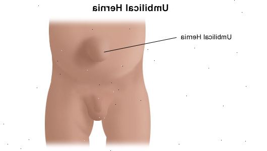 Tyrä korjaus - navan (lapsi). jälkeen andndash; sairaalassa. Tyrä korjaus - navan (lapsi). jälkeen andndash; sairaalassa.