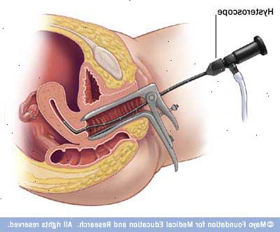 Hysteroscopy. jälkeen andndash; sairaalassa. Hysteroscopy. jälkeen andndash; sairaalassa.