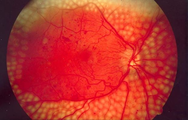 Laserhoitoa diabeettisen retinopatian. jälkeen andndash; sairaalassa. Laserhoitoa diabeettisen retinopatian. jälkeen andndash; sairaalassa.