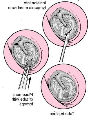 Myringotomy. jälkeen andndash; sairaalassa. Myringotomy. jälkeen andndash; sairaalassa.