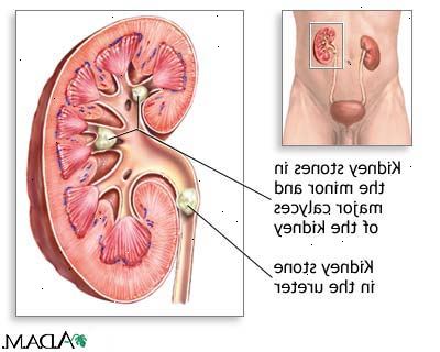 Nephrolithotomy - poistaminen munuaiskivet. jälkeen andndash; sairaalassa. Nephrolithotomy - poistaminen munuaiskivet. jälkeen andndash; sairaalassa.