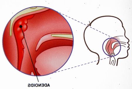 Nielurisojen poisto ja adenoidectomy - lapsi. jälkeen andndash; sairaalassa. Nielurisojen poisto ja adenoidectomy - lapsi. jälkeen andndash; sairaalassa.