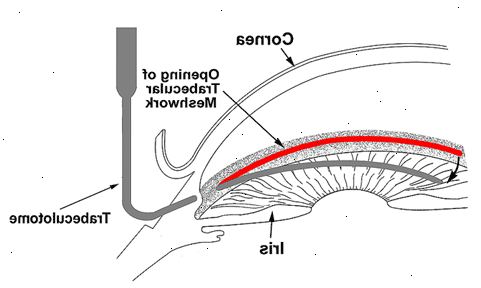 Trabeculotomy. jälkeen andndash; sairaalassa. Trabeculotomy. jälkeen andndash; sairaalassa.