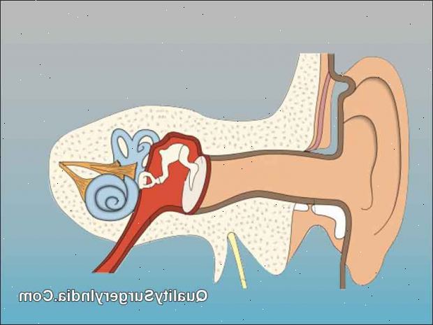 Tympanoplastia - Myringoplastia (aikuinen). jälkeen andndash; sairaalassa. Tympanoplastia - Myringoplastia (aikuinen). jälkeen andndash; sairaalassa.