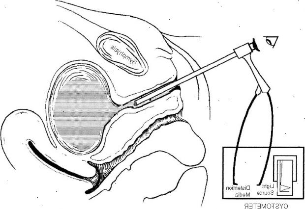 Urethroscopy. jälkeen andndash; sairaalassa. Urethroscopy. jälkeen andndash; sairaalassa.