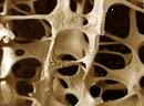 Osteoporoosi