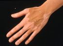 Pigmentti ja vitiligo