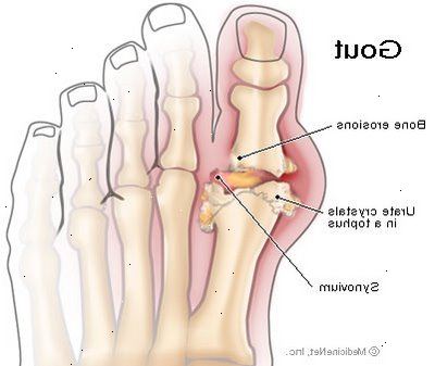 Kihti (podagra tai virtsahapon arthropathy). mikä on syy kihti? Kihti (podagra tai virtsahapon arthropathy). mikä on syy kihti?