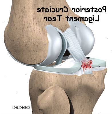Polven vammat - cruciate nivelside. millaisia polvivamman on olemassa? Polven vammat - cruciate nivelside. millaisia polvivamman on olemassa?