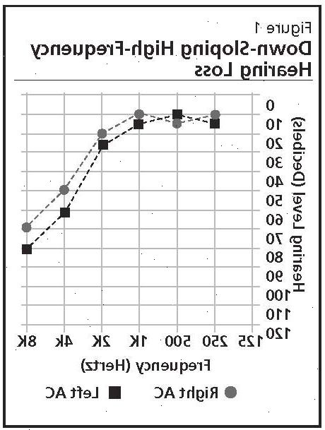 Ikään liittyvä kuulonalenema (presbyacusis). mitkä ovat syyt kuulon? Ikään liittyvä kuulonalenema (presbyacusis). mitkä ovat syyt kuulon?