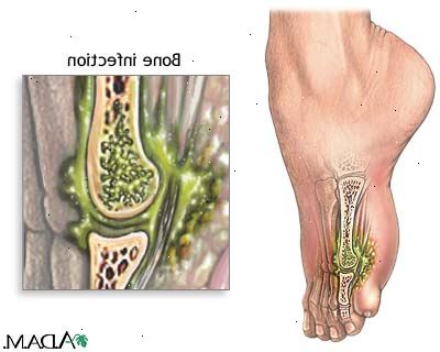 Osteomyeliitti. mikä on osteomyeliitti? Osteomyeliitti. mikä on osteomyeliitti?