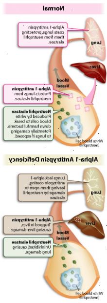 Alfa-1 antitrypsiinivajavuuden. mikä on alfa-1 antitrypsiinivajavuuden? Alfa-1 antitrypsiinivajavuuden. mikä on alfa-1 antitrypsiinivajavuuden?