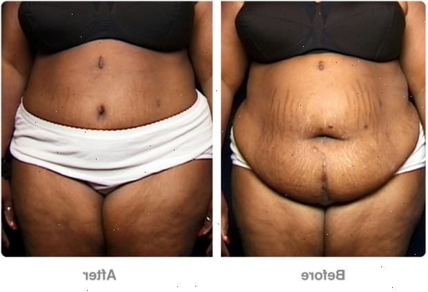 Abdominoplasty. jälkeen andndash; sairaalassa. Abdominoplasty. jälkeen andndash; sairaalassa.