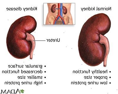 Diabeettinen munuaissairaus. pussidialyysipotilaille. Diabeettinen munuaissairaus. pussidialyysipotilaille.