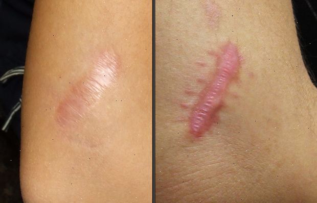 Arvet ja keloids. mikä aiheuttaa arpi muodostaa? Arvet ja keloids. mikä aiheuttaa arpi muodostaa?