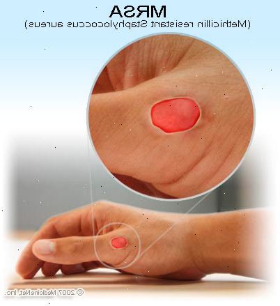 Metisilliiniresistentti Staphylococcus aureus (MRSA)-infektio. MRSA sairaalassa. Metisilliiniresistentti Staphylococcus aureus (MRSA)-infektio. MRSA sairaalassa.