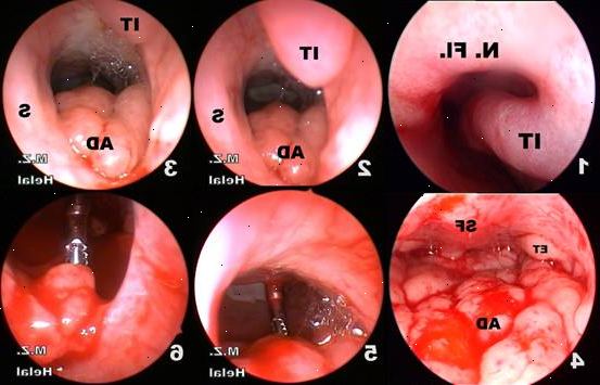 Adenoidectomy. jälkeen andndash; sairaalassa. Adenoidectomy. jälkeen andndash; sairaalassa.