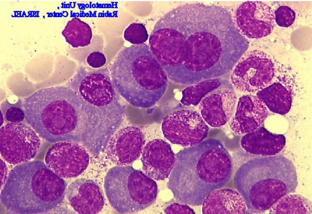 Useita myelooma. leukemia Research Fund. Useita myelooma. leukemia Research Fund.